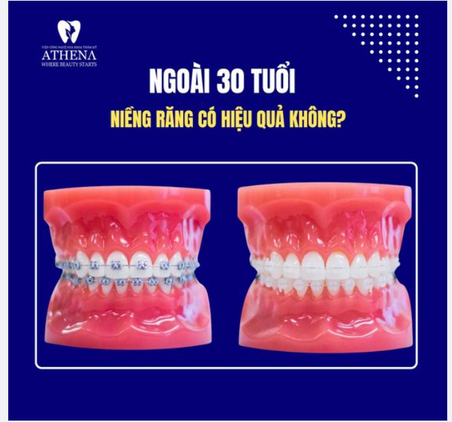 30 tuổi niềng răng được không? Mất bao lâu thời gian?