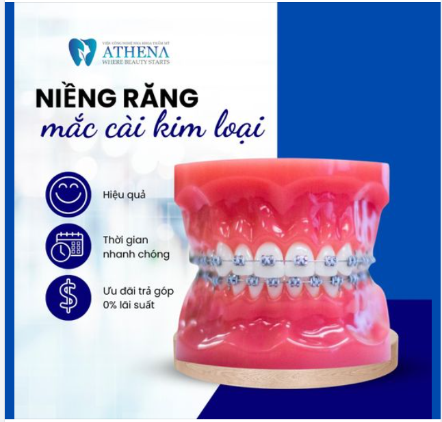 Niềng răng mắc cài với nhiều ưu điểm