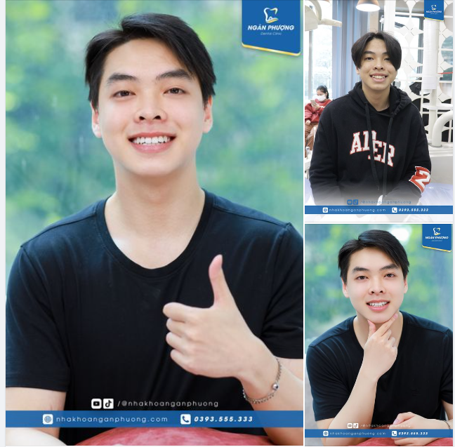Quyết định niềng phút mốt mà thành quả đẹp chuẩn hot boy