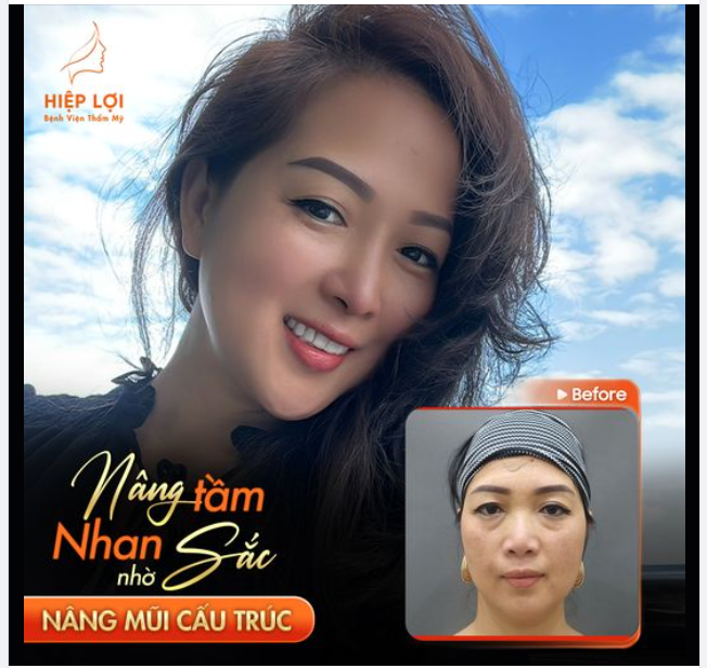 Feedback xinh đẹp từ chị khách - Mũi đẹp tự nhiên, thanh thoát sau khi thực hiện nâng mũi tại Hiệp Lợi