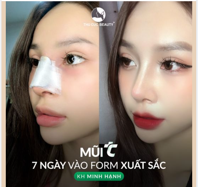 Chiêm ngưỡng dáng mũi sau 7 ngày của KH Minh Hạnh