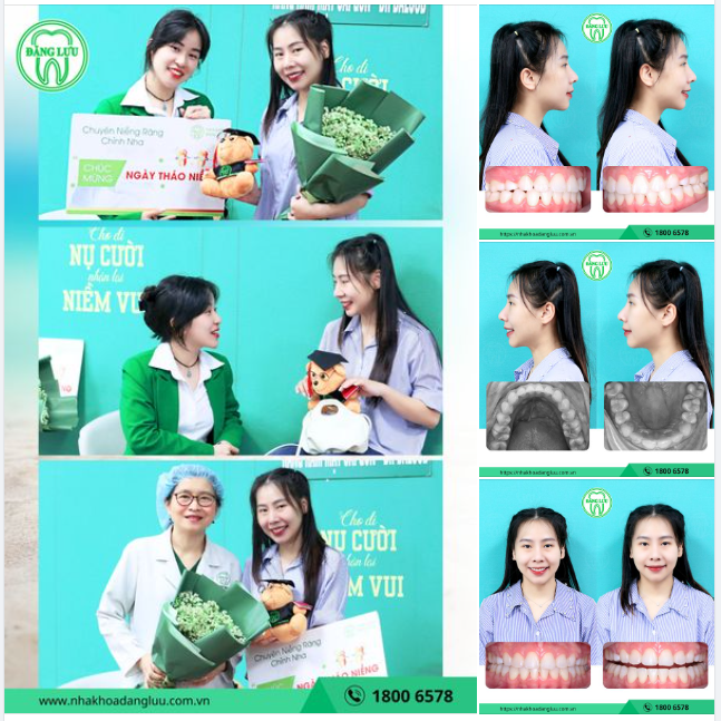 RĂNG XINH, KHỚP CẮN CHUẨN... ĐÃ ĐẾN LÚC THÁO NIỀNG!!!