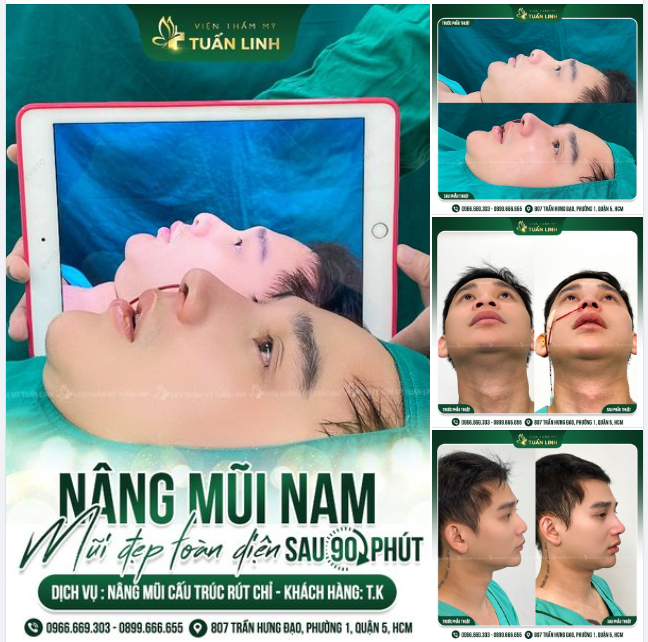 NÂNG MŨI NAM - KHẮC PHỤC MŨI XẤU - LÊN DÁNG MŨI MỚI ĐẸP THỜI THƯỢNG.