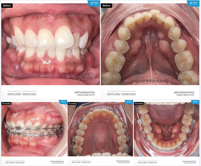 SAU 1,5 NĂM NIỀNG RĂNG (vẫn đang trong quá trình chỉnh nha), hiệu quả nhận thấy rõ ràng