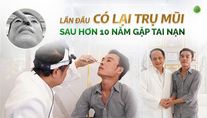 CÓ LẠI MŨI ĐẸP SAU HƠN 10 NĂM BỊ TAI NẠN MŨI