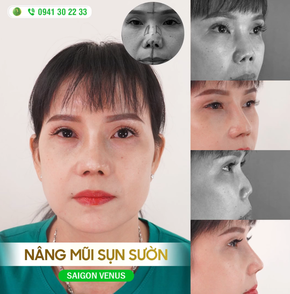 GIẢI CỨU MŨI BIẾN CHỨNG, LẤY LẠI VẺ NGOÀI TỰ TIN CHO CHỊ KHÁCH HÀNG