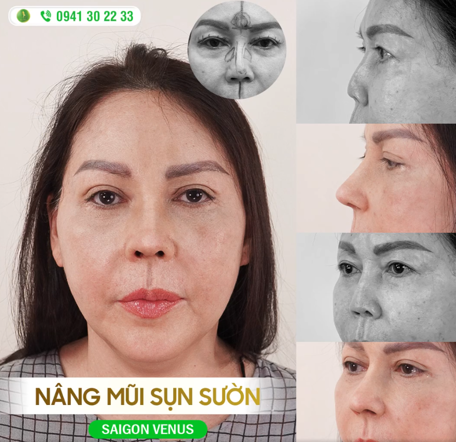 MŨI ĐẸP, BỀN NHỜ CÔNG NGHỆ SỤN SƯỜN FASCIA