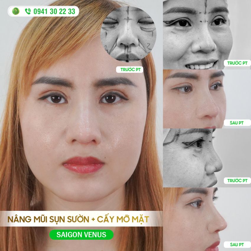 TÁI SINH TỶ LỆ VÀNG - NÂNG MŨI SỬA LẠI KẾT HỢP CẤY MỠ MẶT