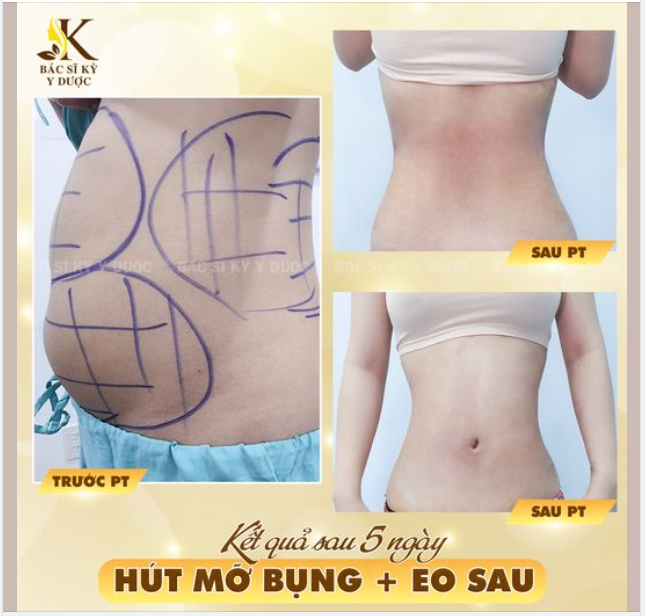 HÚT MỠ BỤNG - EO SAU