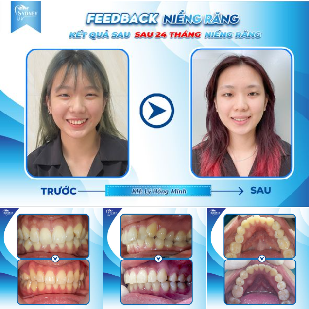 KẾT QUẢ SAU 24 THÁNG NIỀNG RĂNG
