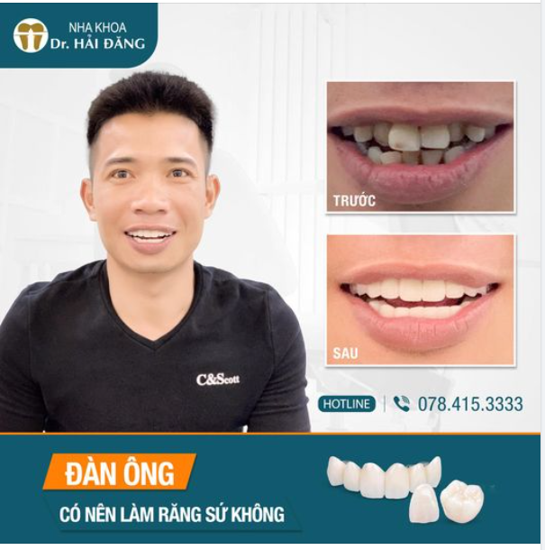 NAM GIỚI CÓ NÊN LÀM RĂNG SỨ KHÔNG