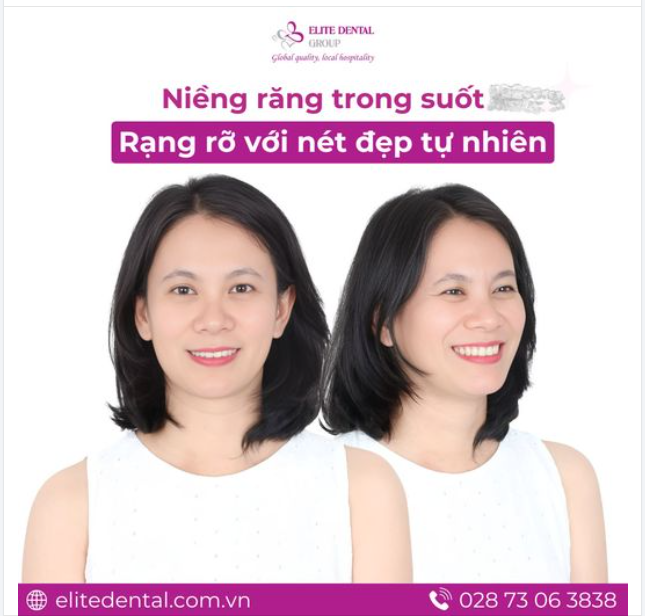 Niềng răng trong suốt: Ngăn ngừa đau khớp hàm, nụ cười khỏe đẹp toàn diện