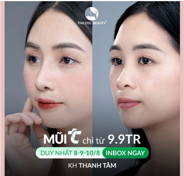 Xóa sổ mũi thấp cho chị khách hàng ngay chỉ sau 30P thực hiện
