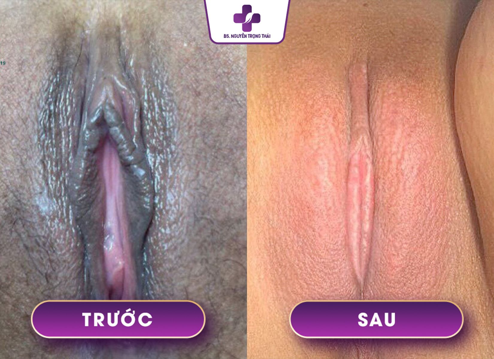 Hình ảnh tái tạo vùng kín hư tổn thành công 