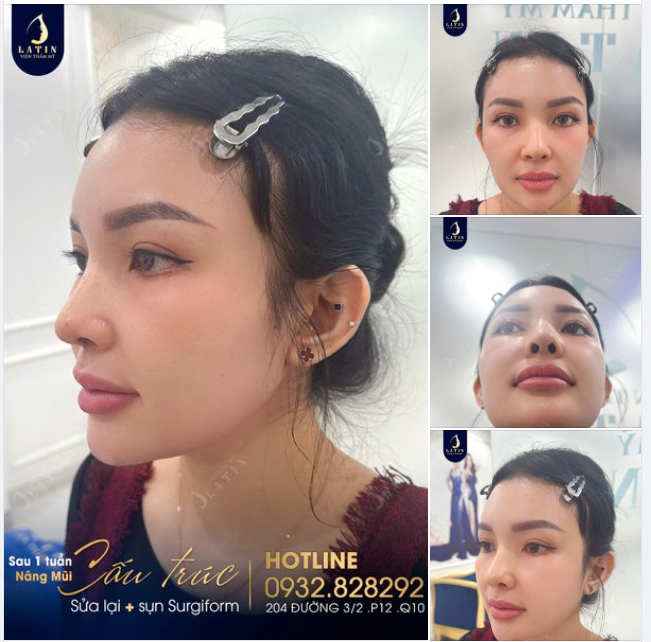 Chị B.T Hạnh Phúc Sau Khi Sửa Mũi Thành Công