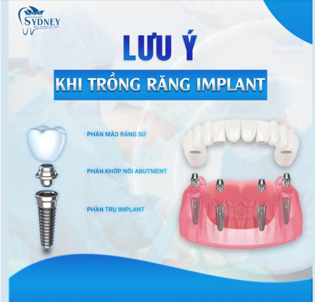 LƯU Ý KHI TRỒNG RĂNG IMPLANT
