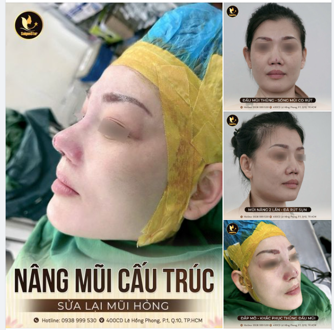 THÀNH CÔNG GIẢI CỨU MŨI HỎNG SAU 2 LẦN NÂNG - GIÚP CHỊ KHÁCH HÀNG TÌM LẠI DÁNG MŨI BÌNH THƯỜNG
