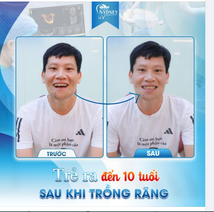 TRẺ RA ĐẾN 10 TUỔI SAU KHI TRỒNG RĂNG