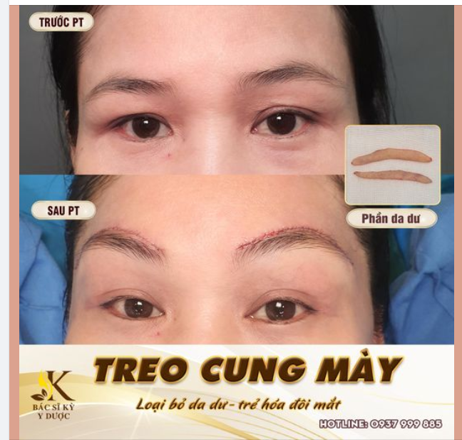 TREO CUNG MÀY - TẠO CUNG CHÂN MÀY PHONG THỦY