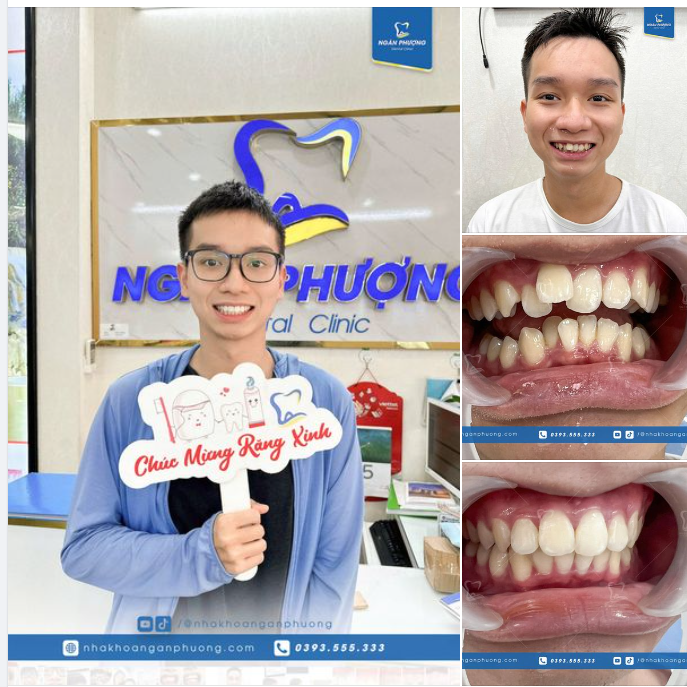 Tháo niềng là vừa hay tốt nghiệp