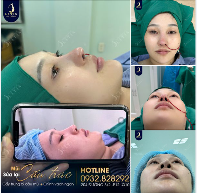 Em gái quê Hậu giang lên Sài Gòn sửa mũi