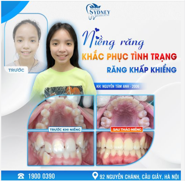 NIỀNG RĂNG - KHẮC PHỤC TÌNH TRẠNG RĂNG KHẤP KHỂNH