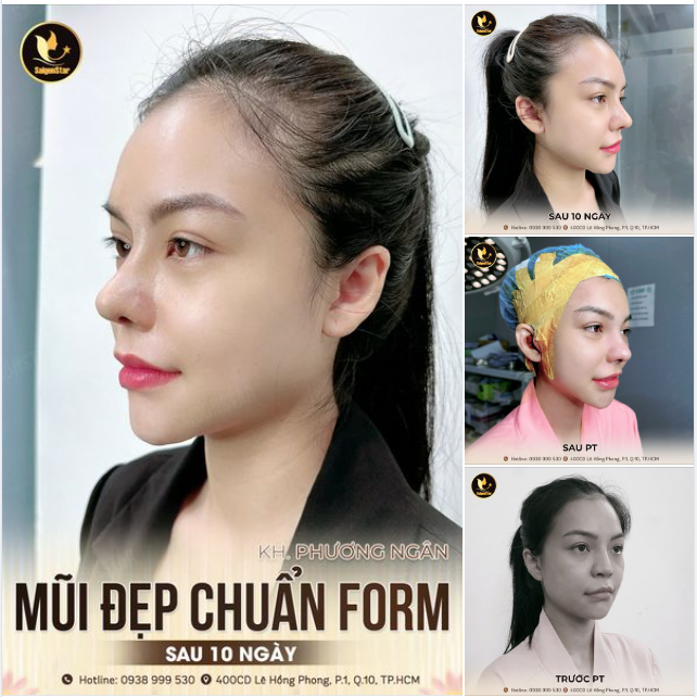 10 NGÀY MŨI ĐẸP CHUẨN FORM - NHAN SẮC RẠNG NGỜI