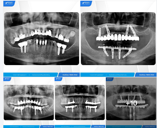 ALBUM TÁI KHÁM IMPLANT chọn lọc những ca lâm sàng Implant được cấy ghép tại Peace Dentistry từ 5 năm trở lên