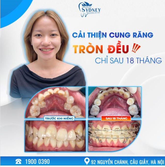CẢI THIỆN CUNG RĂNG TRÒN ĐỀU CHỈ SAU 18 THÁNG