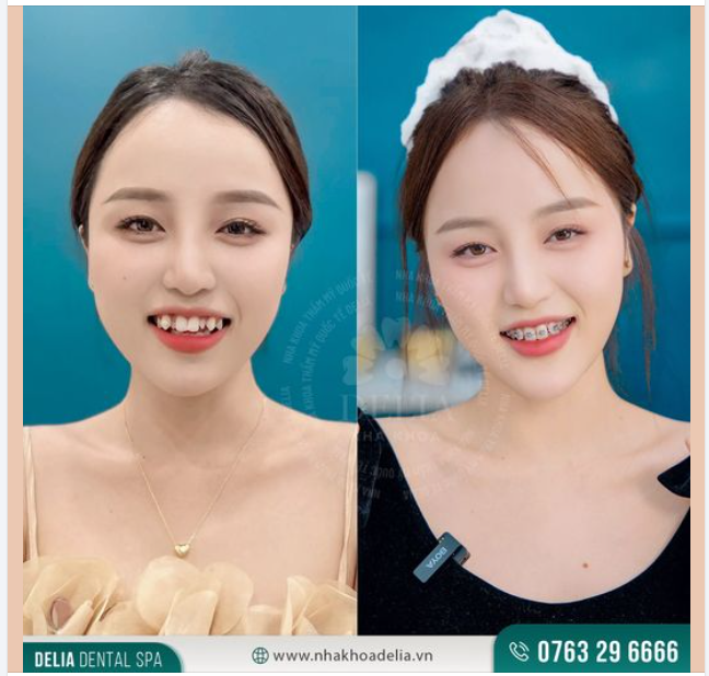 SAU 1 NĂM NIỀNG RĂNG KHÁCH HÀNG ĐÃ THAY ĐỔI THẾ NÀO?