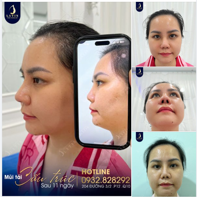Em gái tìm được dáng mũi ưng ý sau khi nâng mũi không thành công ở nơi khác