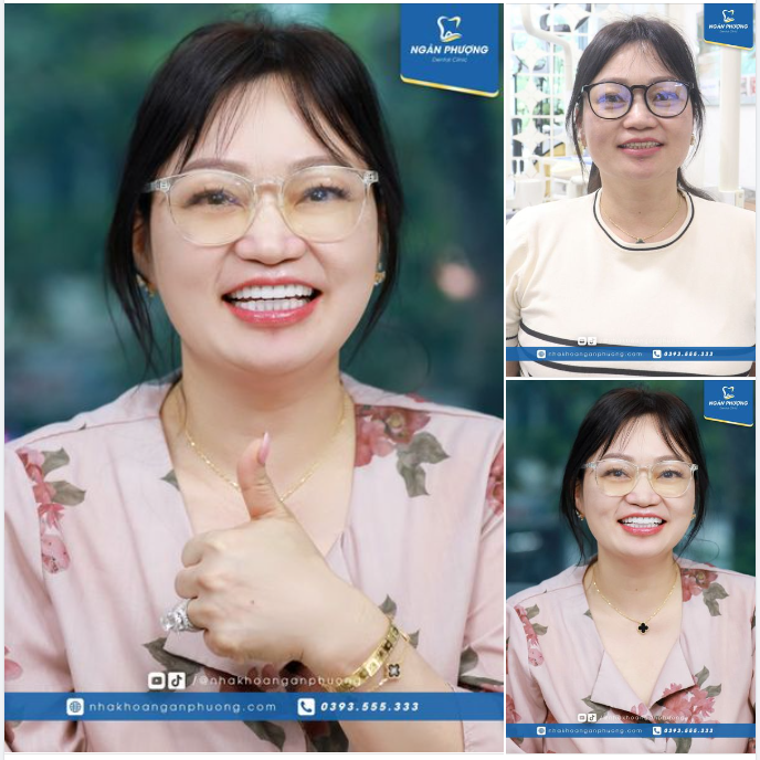 "Từ lúc làm xong chị chỉ muốn cười thôi" - Chị Hà Lê chia sẻ sau hành trình vượt 17.000km về Ngân Phượng làm lại răng sứ