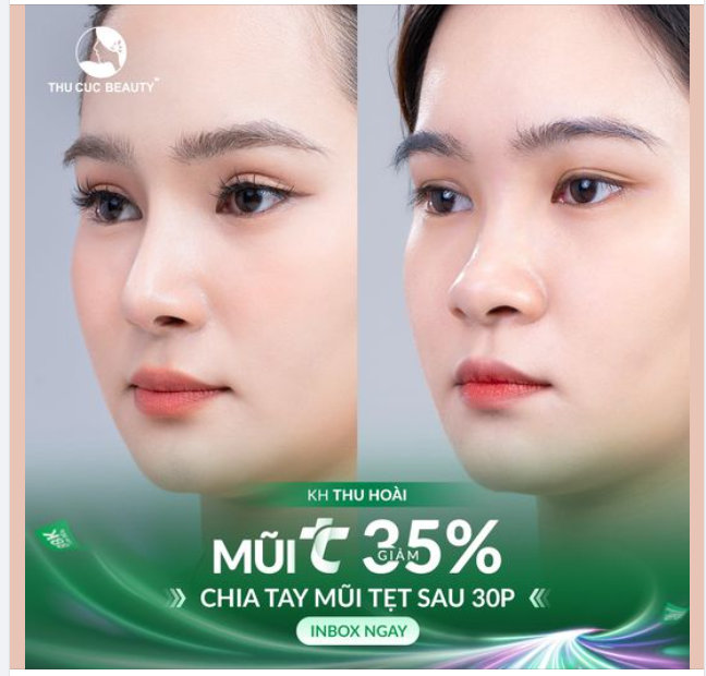 Loại bỏ sống mũi thấp - Hô biến ngay góc nghiêng thần thánh