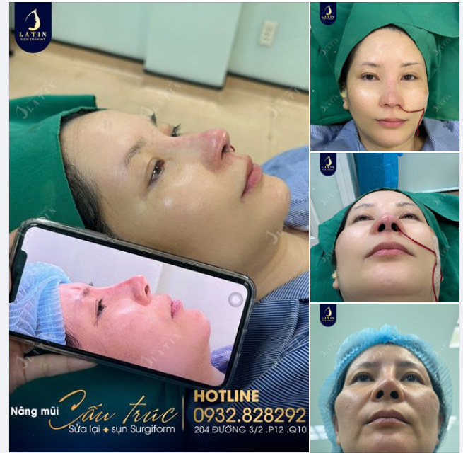 Nỗi lo lắng về lần nâng mũi trước đó không thành công khiến chị N.K giảm sút sự tự tin.