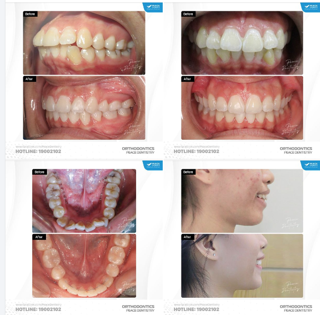 TỪ RĂNG HÔ ĐẾN NỤ CƯỜI TỰ TIN | 24 THÁNG 'BIẾN HÌNH' CÙNG PEACE DENTISTRY VÀ CƠ HỘI TIẾT KIỆM LÊN ĐẾN 13.500.000Đ