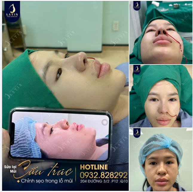 Kết quả ca mũi sửa lại vừa hoàn thành cho em gái