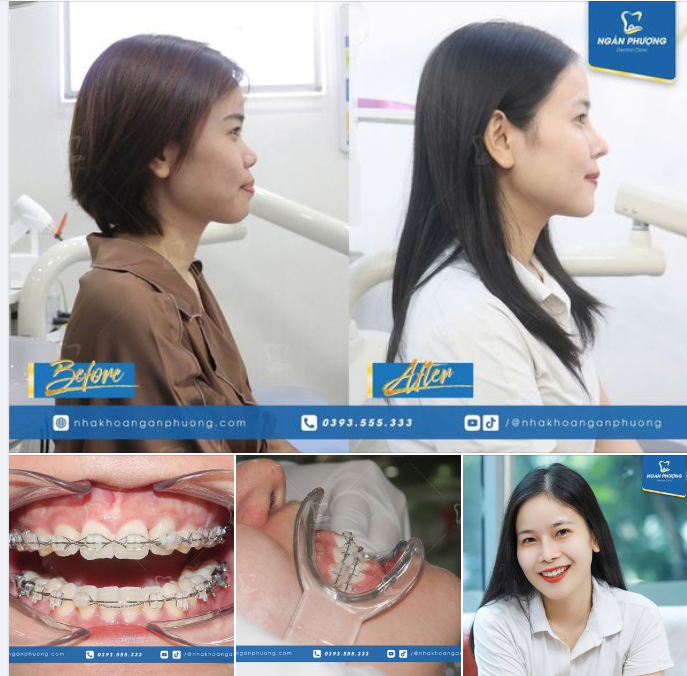Răng đều rồi sao còn phải niềng? Tham khảo ngay case của bạn Lê Chinh dưới đây nhé