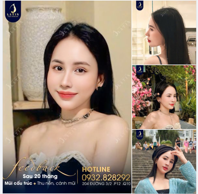Feeback mũi cấu trúc 2 năm tuổi