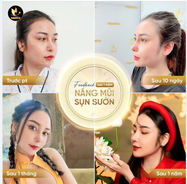 GÓC FEEDBACK - NHÂN CHỨNG HOÀN HẢO CHO DÁNG MŨI CẤU TRÚC NHÀ DR.HOẠT