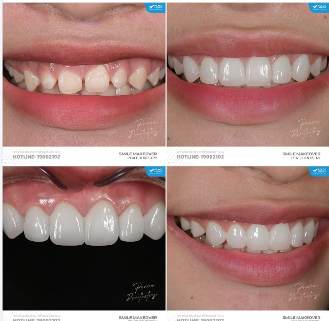 CẮT NƯỚU LASER  VENEER VÙNG RĂNG CỬA