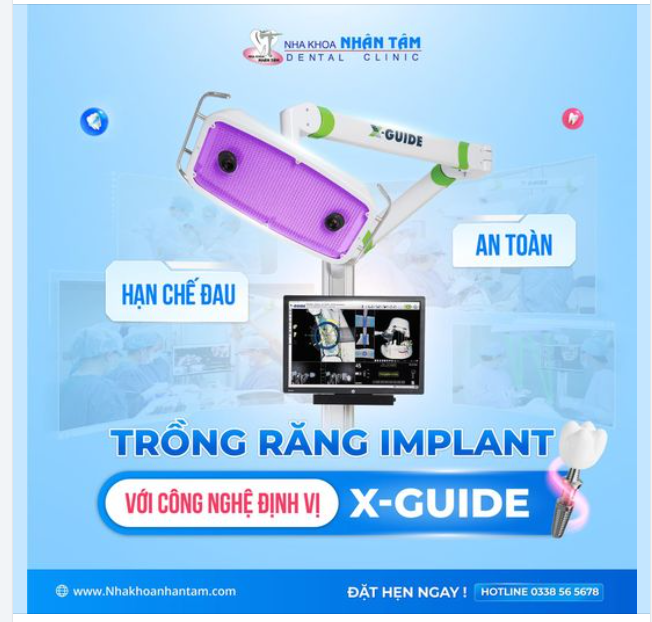 Trồng răng Implant với công nghệ định vị. An toàn - Hạn chế đau. Sau 1h - Có răng ăn nhai!