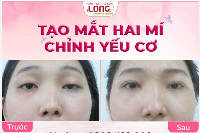 CẮT MÍ CHỈNH YẾU CƠ ƯU ĐÃI ĐẾN BẤT NGỜ