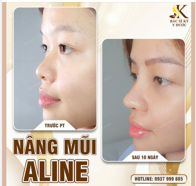 CHỊ EM NÀO MŨI THẤP, MŨI TẸT THÌ KHÔNG ĐƯỢC BỎ QUA BÀI VIẾT NÀY!!