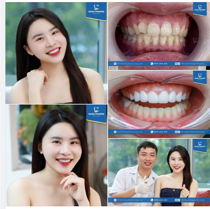 Răng sứ rạng rỡ nụ cười. Như hoa mới nở, như người trong tranh