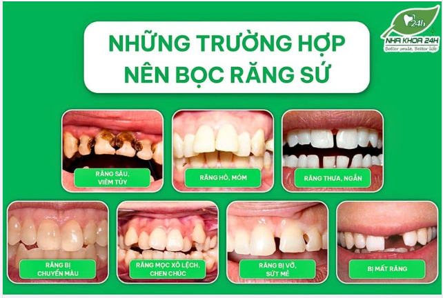 Các trường hợp cần bọc răng sứ