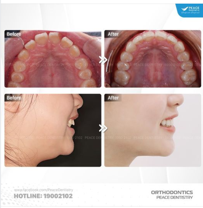 Bạn từng mơ ước về một hàm răng đều đẹp, một nụ cười tự tin?