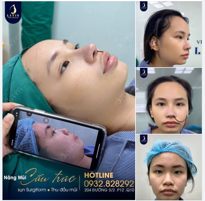 Mũi cấu trúc chiếm chọn điểm 10 hài lòng từ em gái