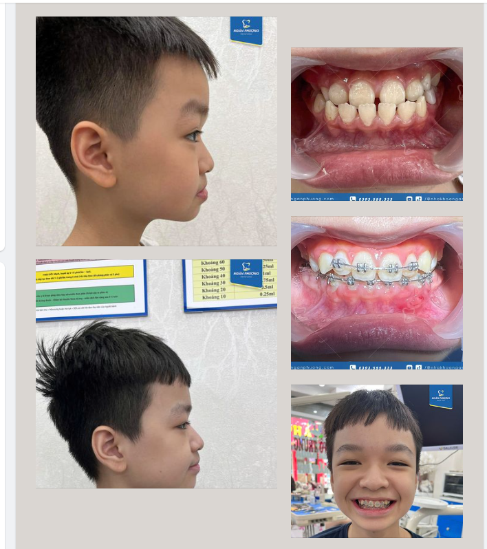 Hành trình hết khớp cắn ngược chỉ sau vài tháng ngắn ngủi