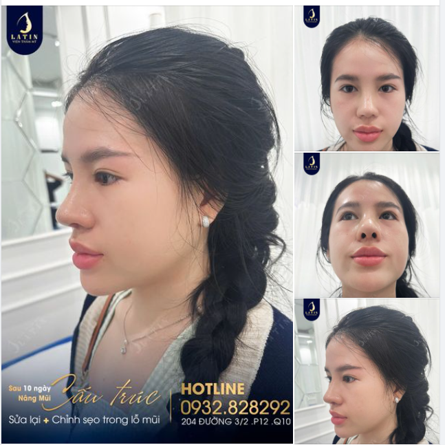 Mũi sửa lại sau 10 ngày lên dáng như ý cho em gái