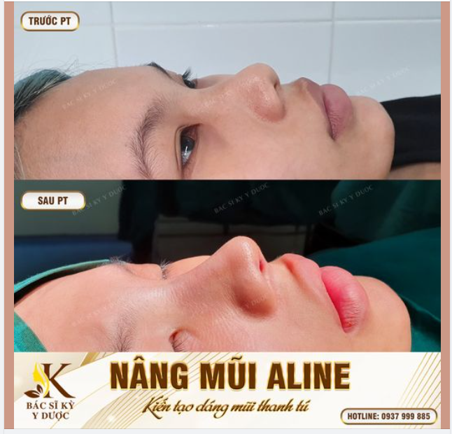 NÂNG MŨI ALINE - KIẾN TẠO DÁNG MŨI THANH TÚ